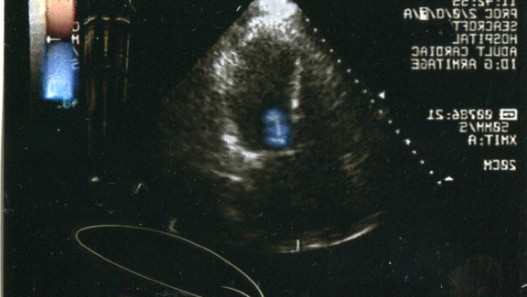 Adult Cardiac